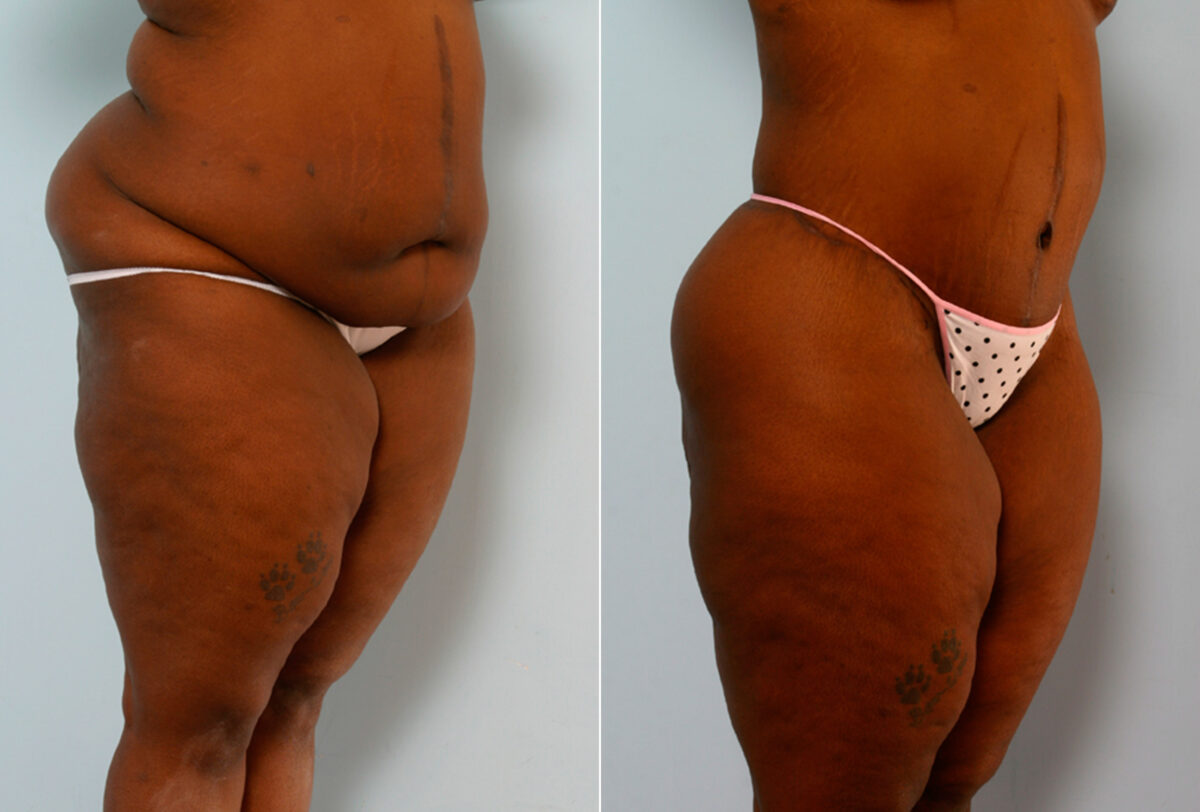 Body Lift before and after photos in Houston, TX, Patient 26695