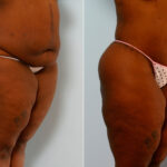 Body Lift before and after photos in Houston, TX, Patient 26695