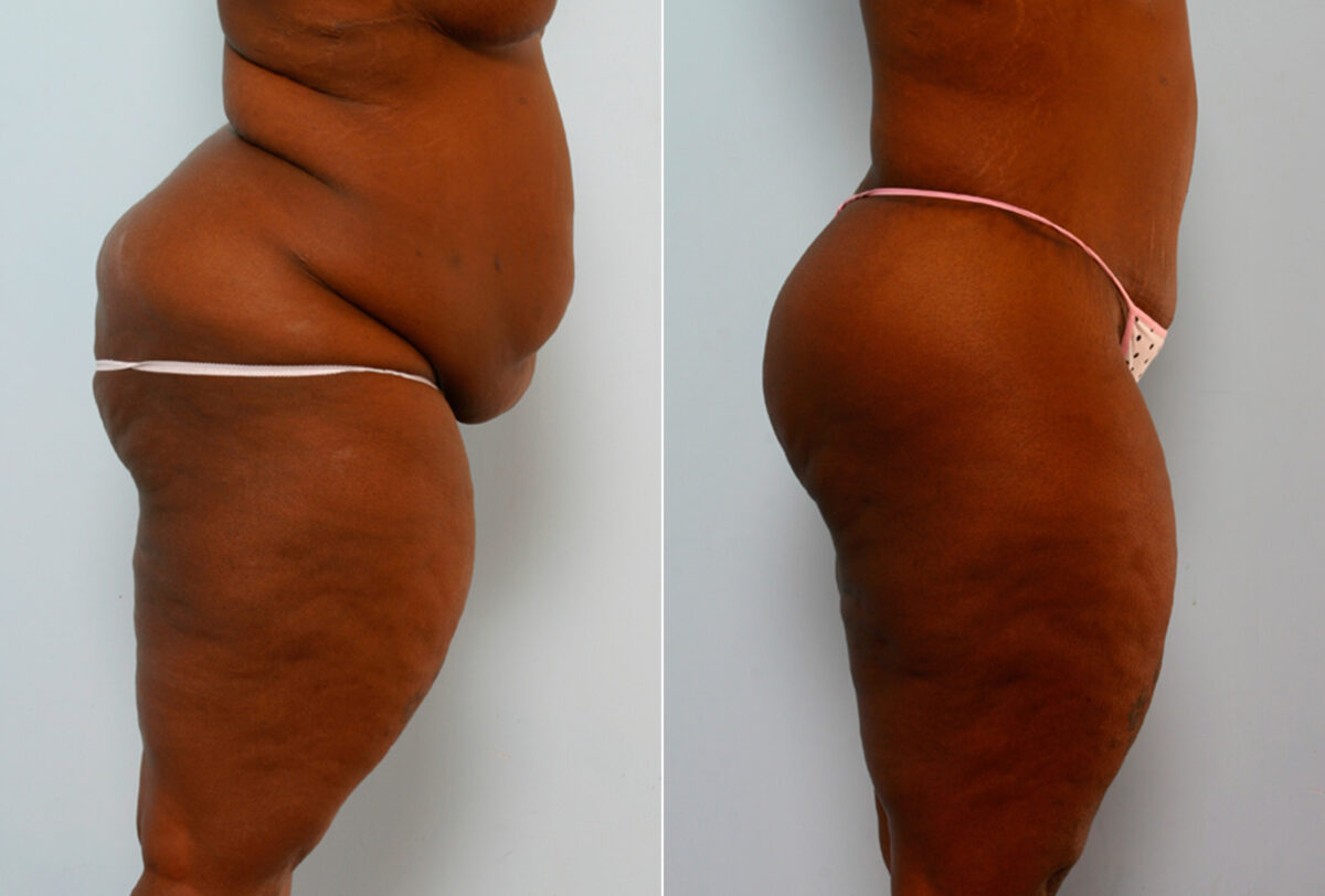 Body Lift before and after photos in Houston, TX, Patient 26695