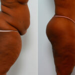 Body Lift before and after photos in Houston, TX, Patient 26695