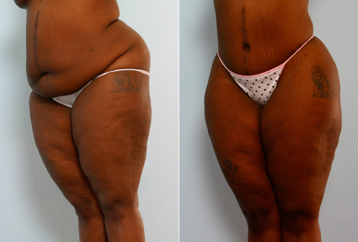 Body Lift before and after photos in Houston, TX, Patient 26695