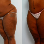 Body Lift before and after photos in Houston, TX, Patient 26695