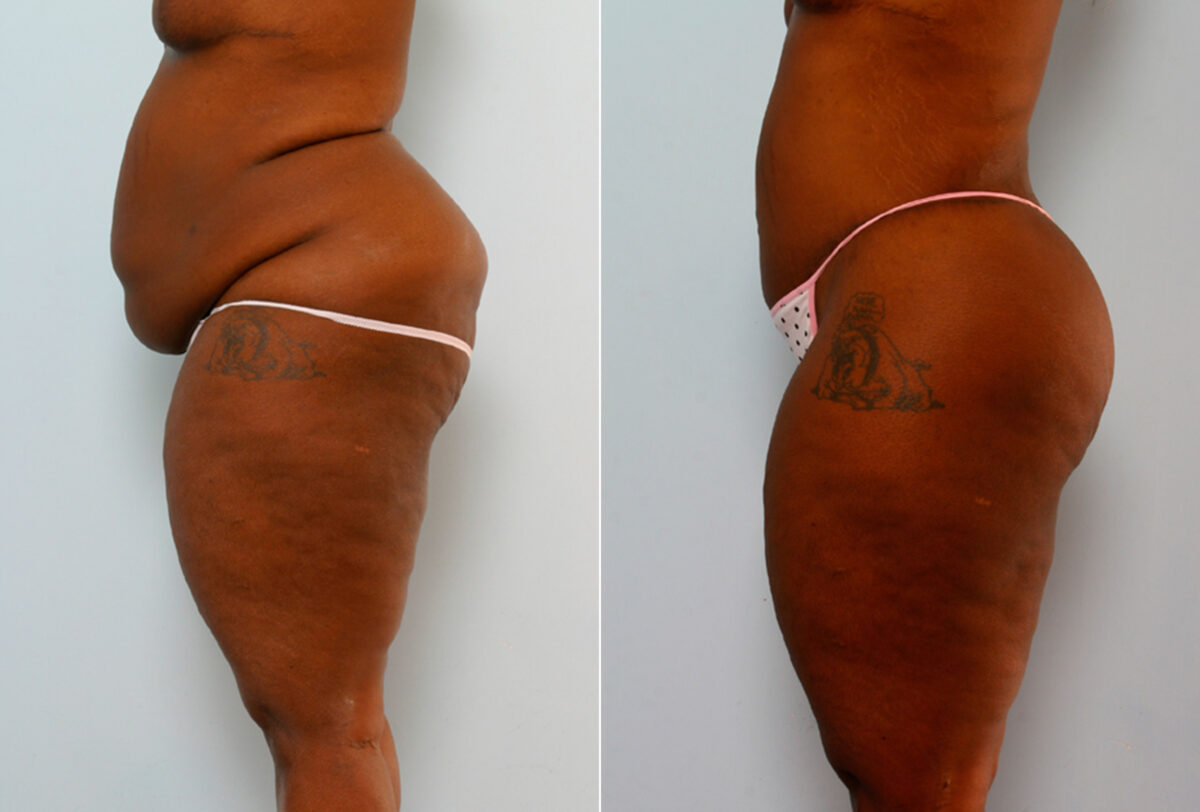 Body Lift before and after photos in Houston, TX, Patient 26695