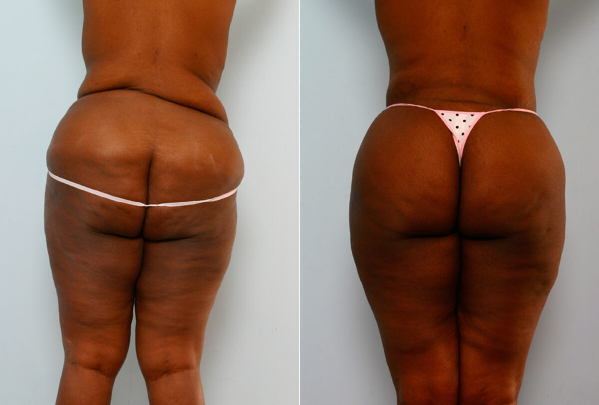 Body Lift before and after photos in Houston, TX, Patient 26695