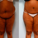 Body Lift before and after photos in Houston, TX, Patient 26708