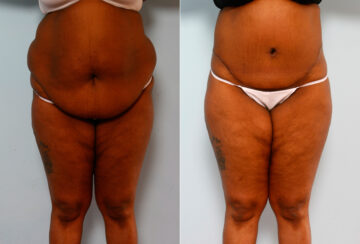 Body Lift before and after photos in Houston, TX, Patient 26708