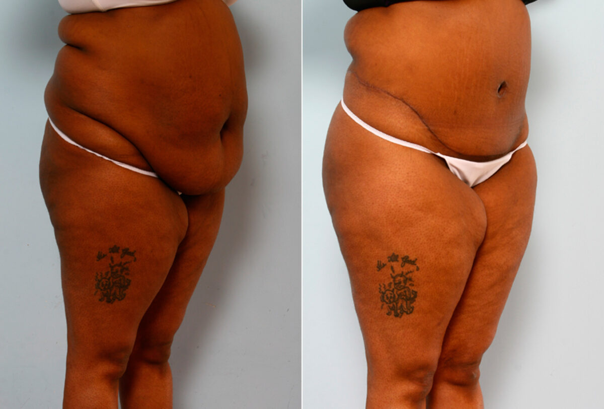 Body Lift before and after photos in Houston, TX, Patient 26708