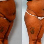 Body Lift before and after photos in Houston, TX, Patient 26708