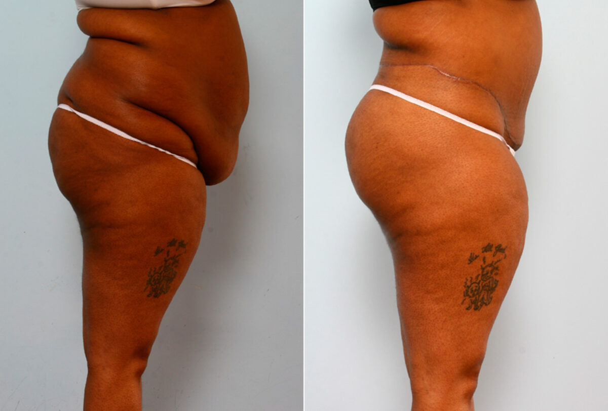 Body Lift before and after photos in Houston, TX, Patient 26708