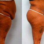 Body Lift before and after photos in Houston, TX, Patient 26708