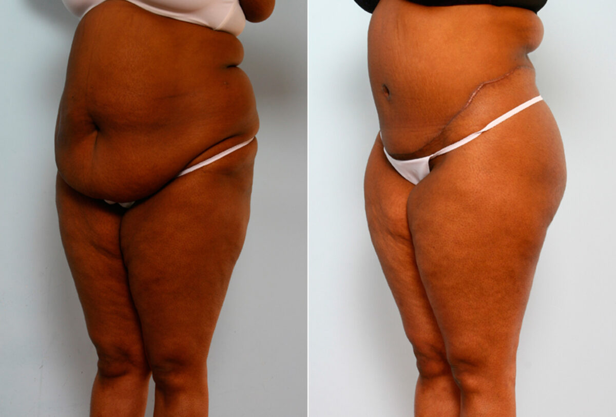 Body Lift before and after photos in Houston, TX, Patient 26708