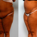 Body Lift before and after photos in Houston, TX, Patient 26708