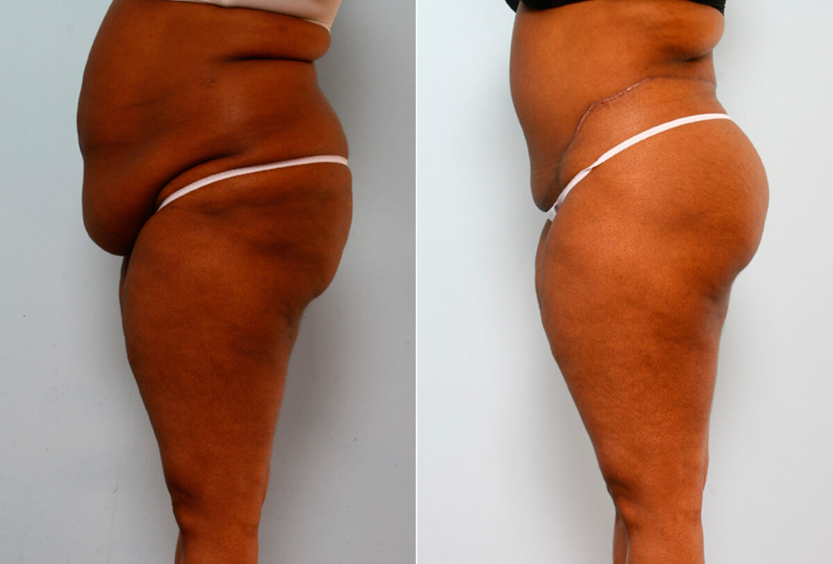 Body Lift before and after photos in Houston, TX, Patient 26708