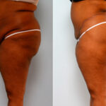 Body Lift before and after photos in Houston, TX, Patient 26708
