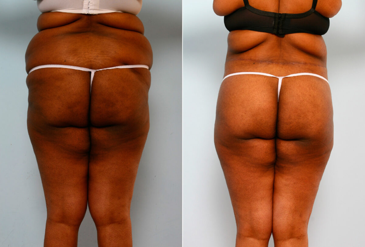 Body Lift before and after photos in Houston, TX, Patient 26708