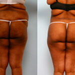 Body Lift before and after photos in Houston, TX, Patient 26708