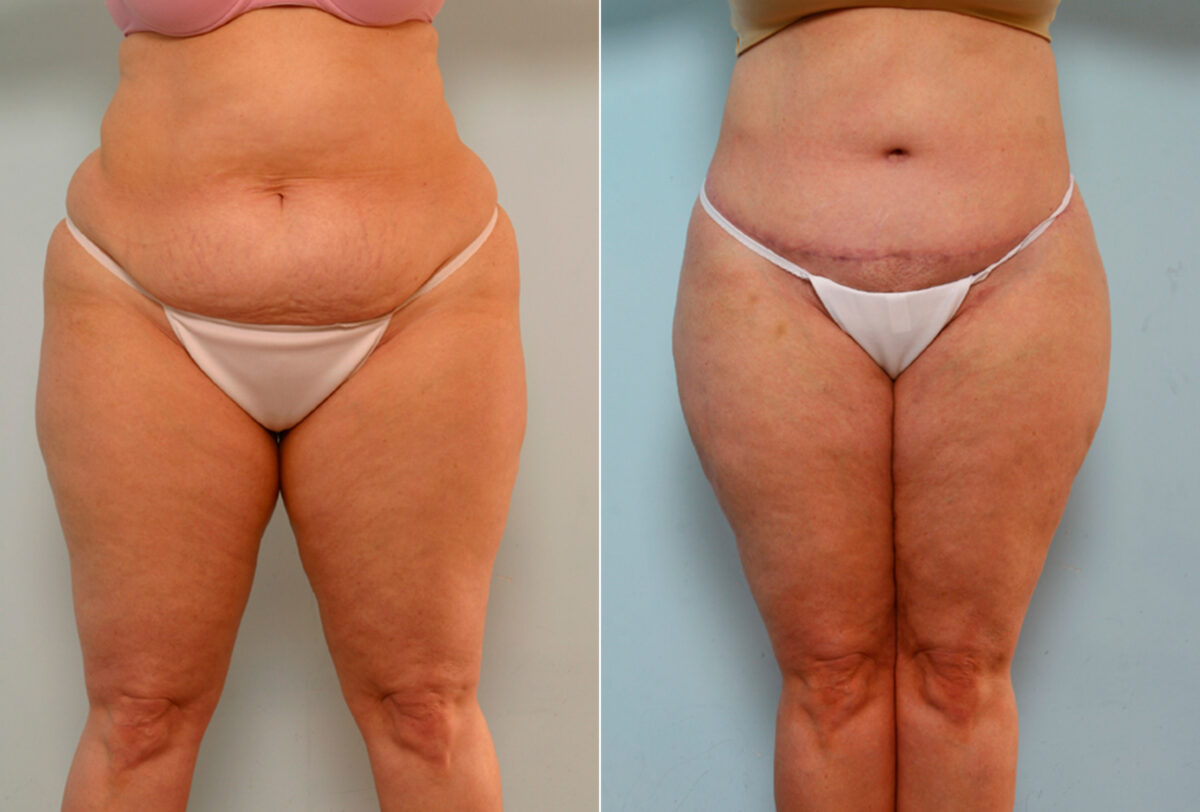 Body Lift before and after photos in Houston, TX, Patient 26734