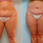 Body Lift before and after photos in Houston, TX, Patient 26734