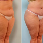 Body Lift before and after photos in Houston, TX, Patient 26734