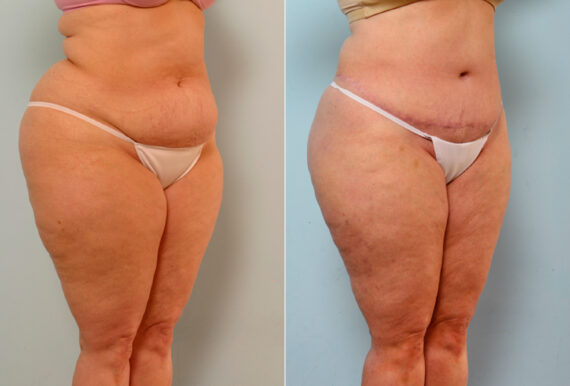 Body Lift before and after photos in Houston, TX, Patient 26734
