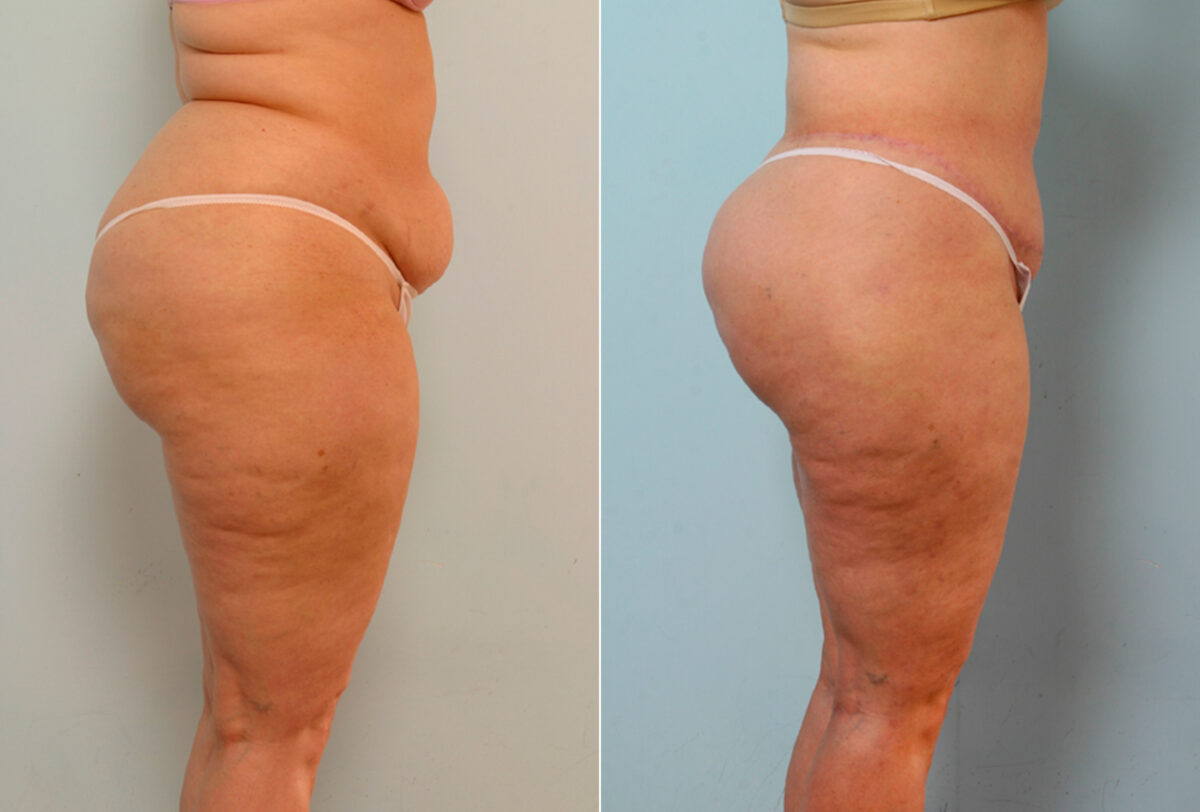 Body Lift before and after photos in Houston, TX, Patient 26734