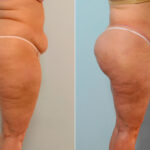 Body Lift before and after photos in Houston, TX, Patient 26734