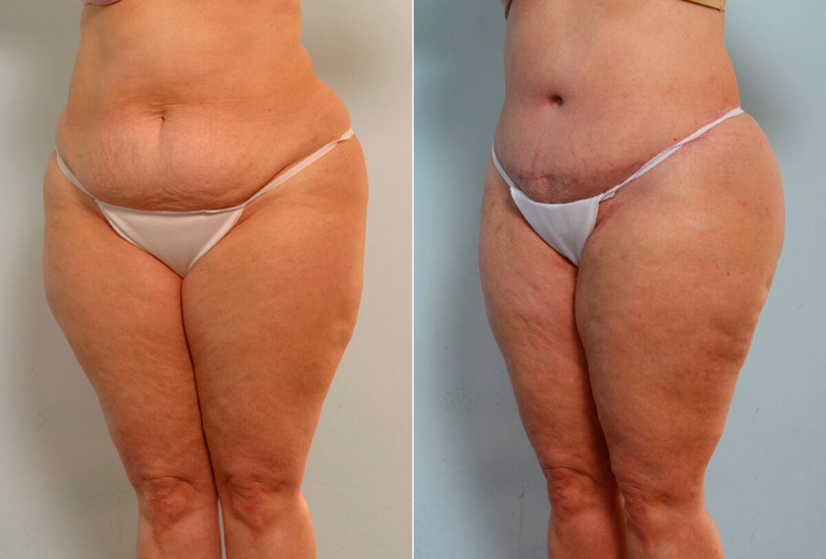 Body Lift before and after photos in Houston, TX, Patient 26734