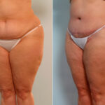 Body Lift before and after photos in Houston, TX, Patient 26734