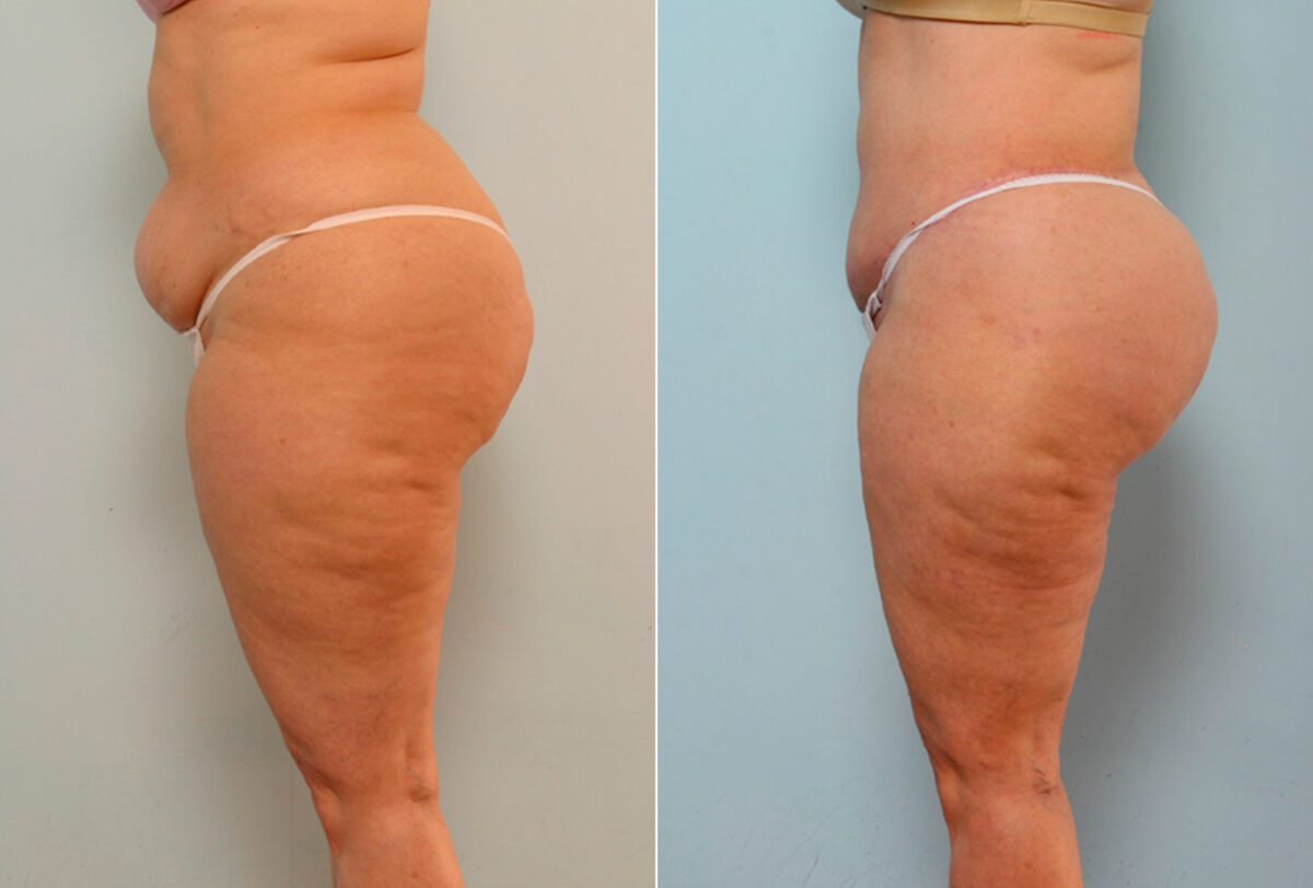 Body Lift before and after photos in Houston, TX, Patient 26734