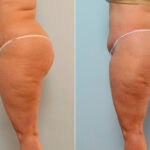 Body Lift before and after photos in Houston, TX, Patient 26734