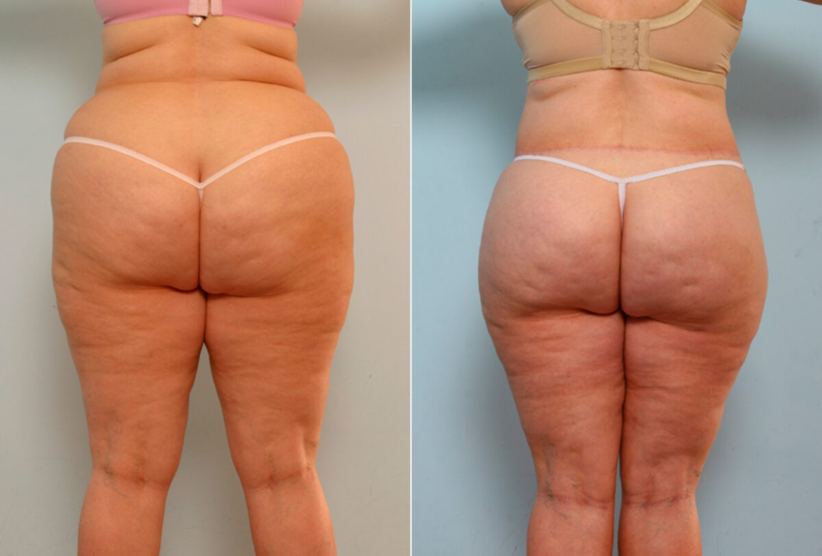 Body Lift before and after photos in Houston, TX, Patient 26734