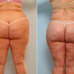 Body Lift before and after photos in Houston, TX, Patient 26734