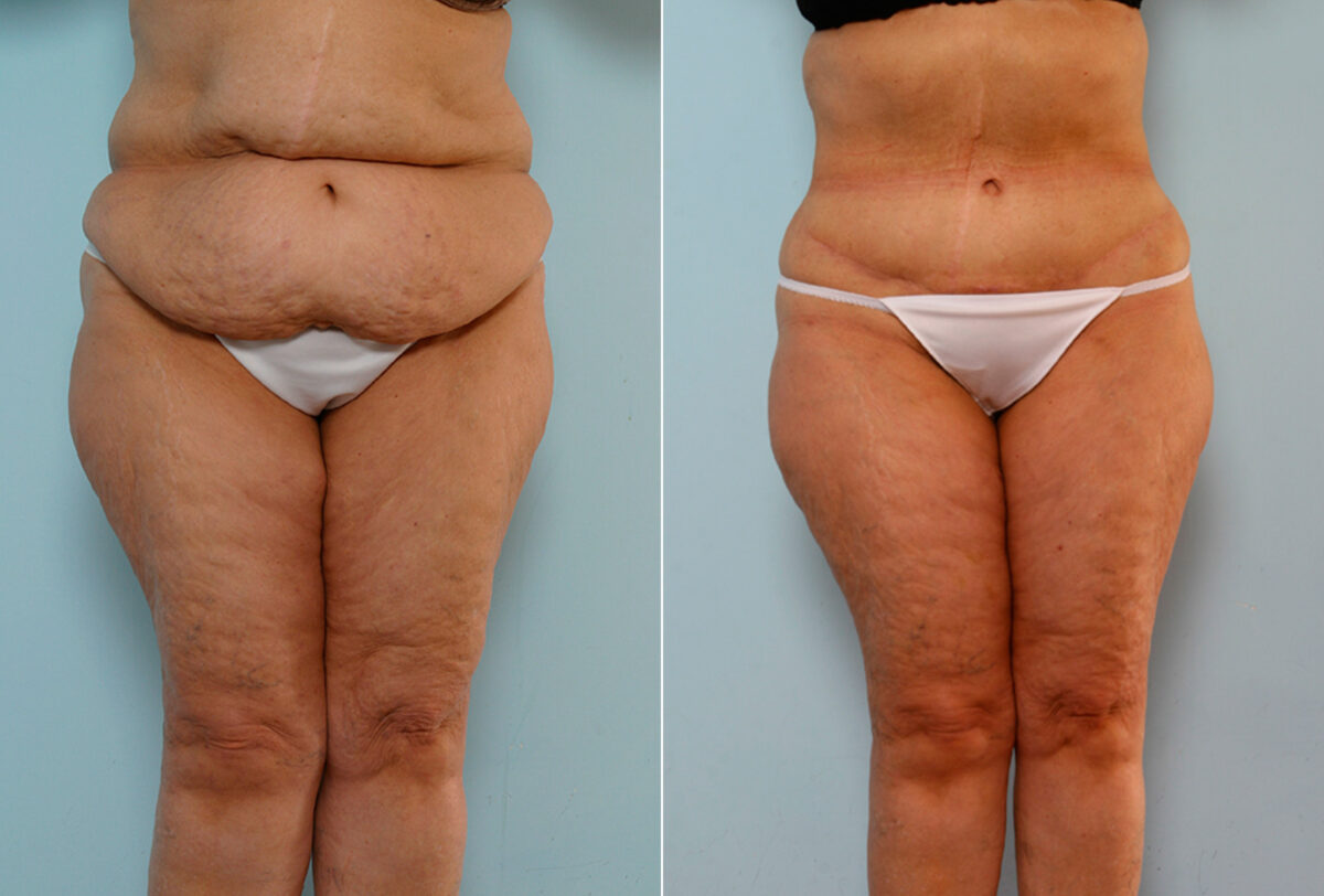 Body Lift before and after photos in Houston, TX, Patient 26747