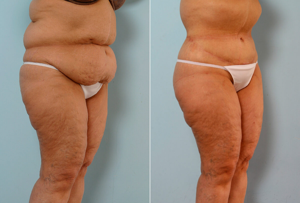 Body Lift before and after photos in Houston, TX, Patient 26747