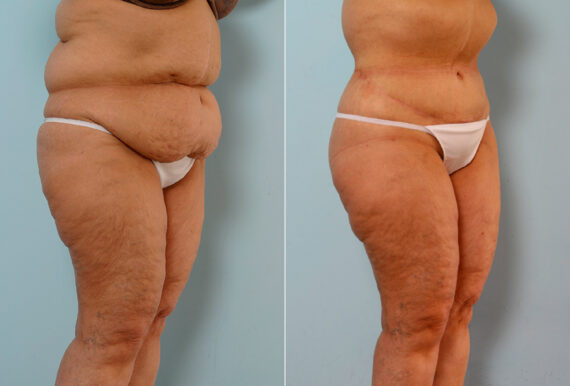 Body Lift before and after photos in Houston, TX, Patient 26747