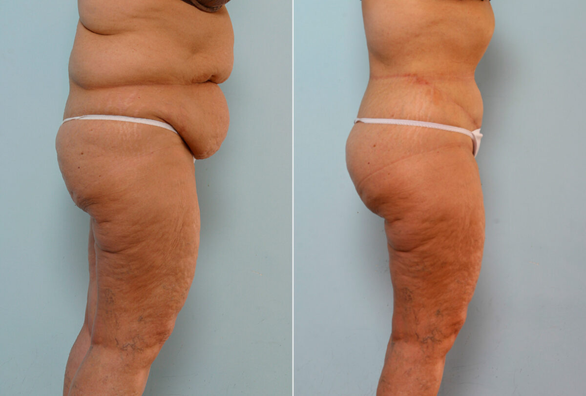 Body Lift before and after photos in Houston, TX, Patient 26747