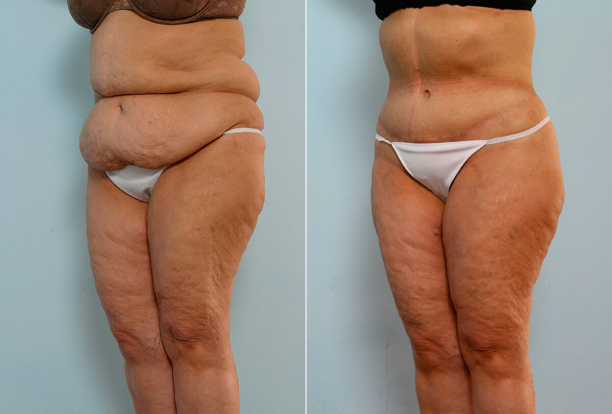 Body Lift before and after photos in Houston, TX, Patient 26747