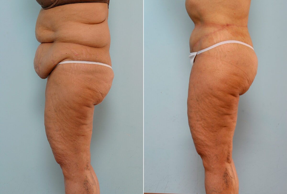 Body Lift before and after photos in Houston, TX, Patient 26747