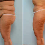 Body Lift before and after photos in Houston, TX, Patient 26747