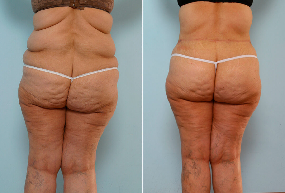 Body Lift before and after photos in Houston, TX, Patient 26747