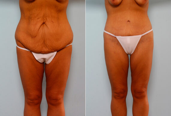 Body Lift before and after photos in Houston, TX, Patient 26760