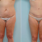 Abdominoplasty before and after photos in Houston, TX, Patient 24457