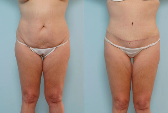 Abdominoplasty before and after photos in Houston, TX, Patient 24457