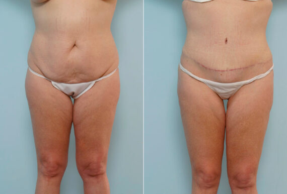 Tummy Tuck/Abdominoplasty before and after photos in Houston, TX, Patient 24457