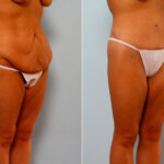 Body Lift before and after photos in Houston, TX, Patient 26760