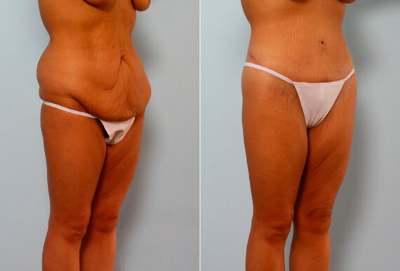 Body Lift before and after photos in Houston, TX, Patient 26760