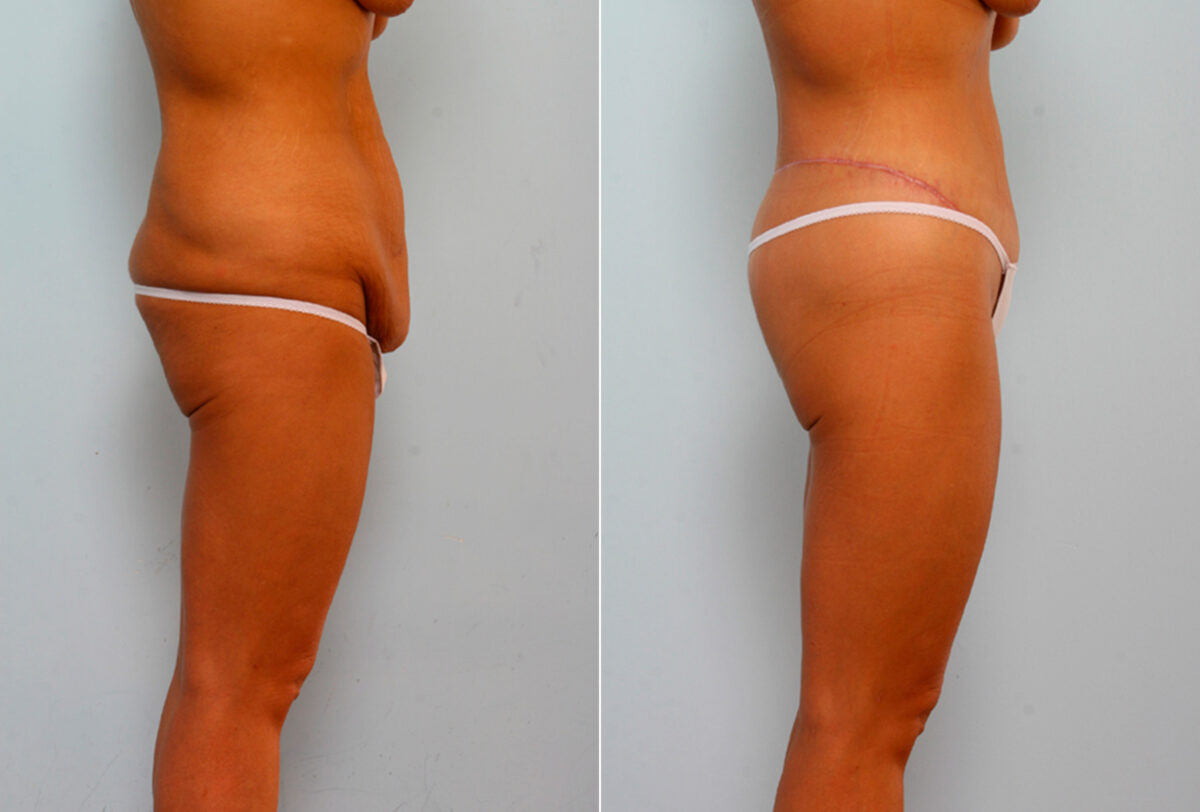 Body Lift before and after photos in Houston, TX, Patient 26760