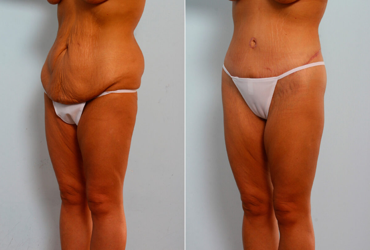 Body Lift before and after photos in Houston, TX, Patient 26760