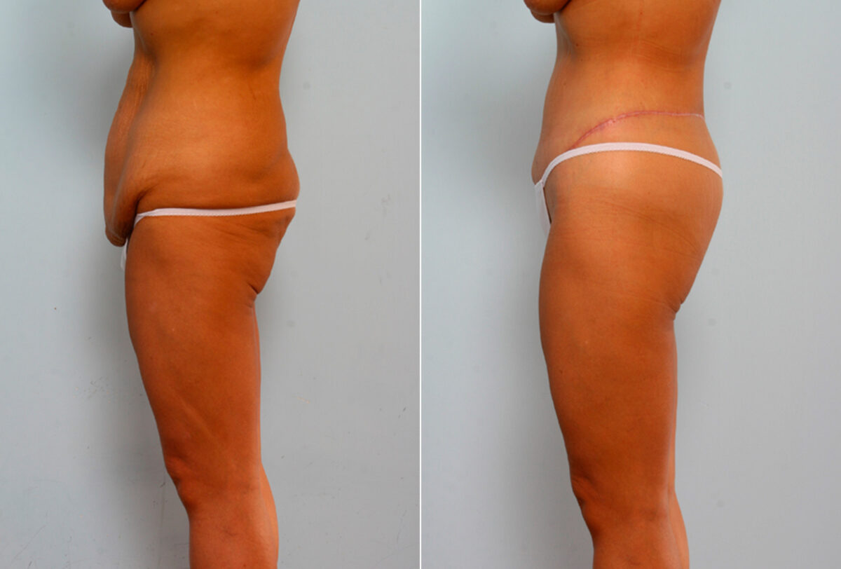 Body Lift before and after photos in Houston, TX, Patient 26760