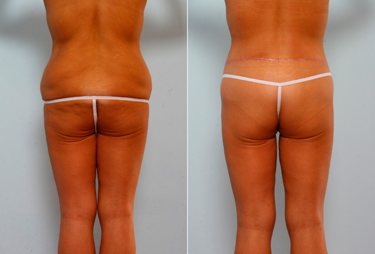 Body Lift before and after photos in Houston, TX, Patient 26760